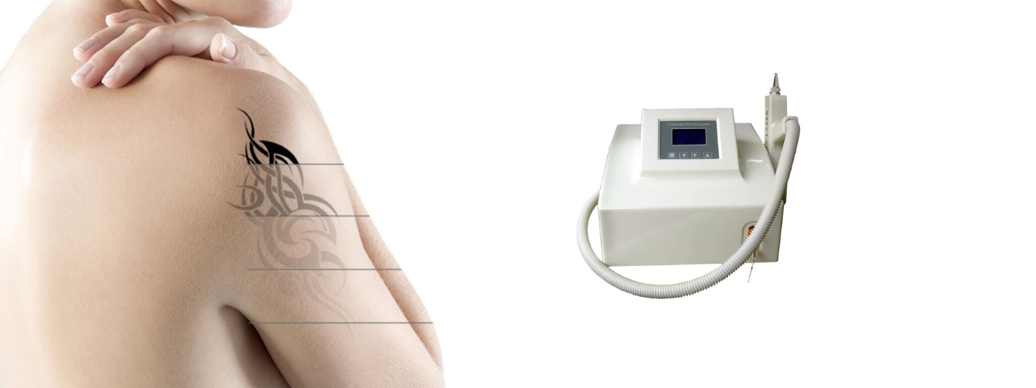 Laser Emay Q-Switch - Minas Laser Locações - Lavras MG